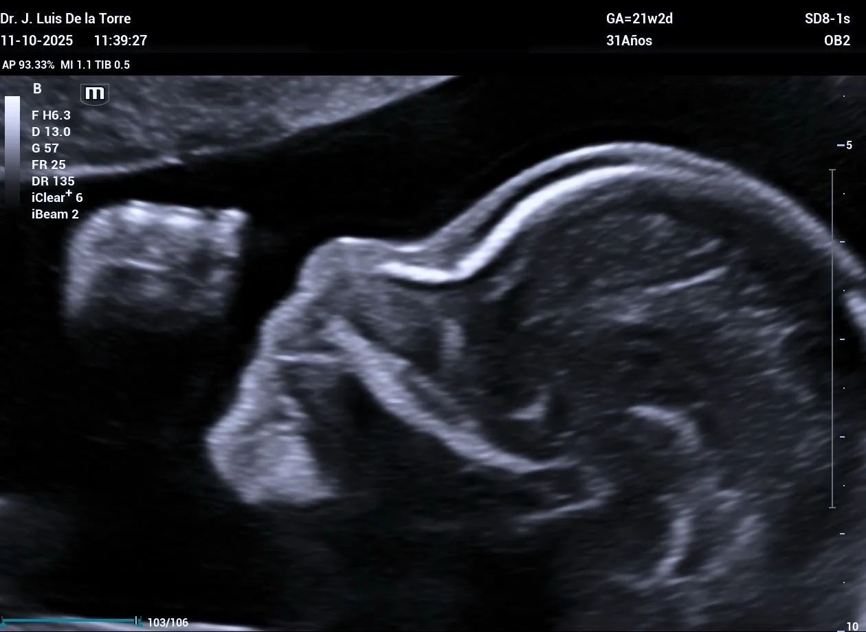Ultrasonido Estructural